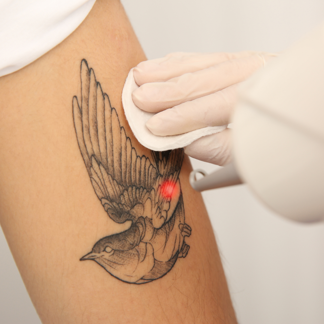Tattoo Removal Process